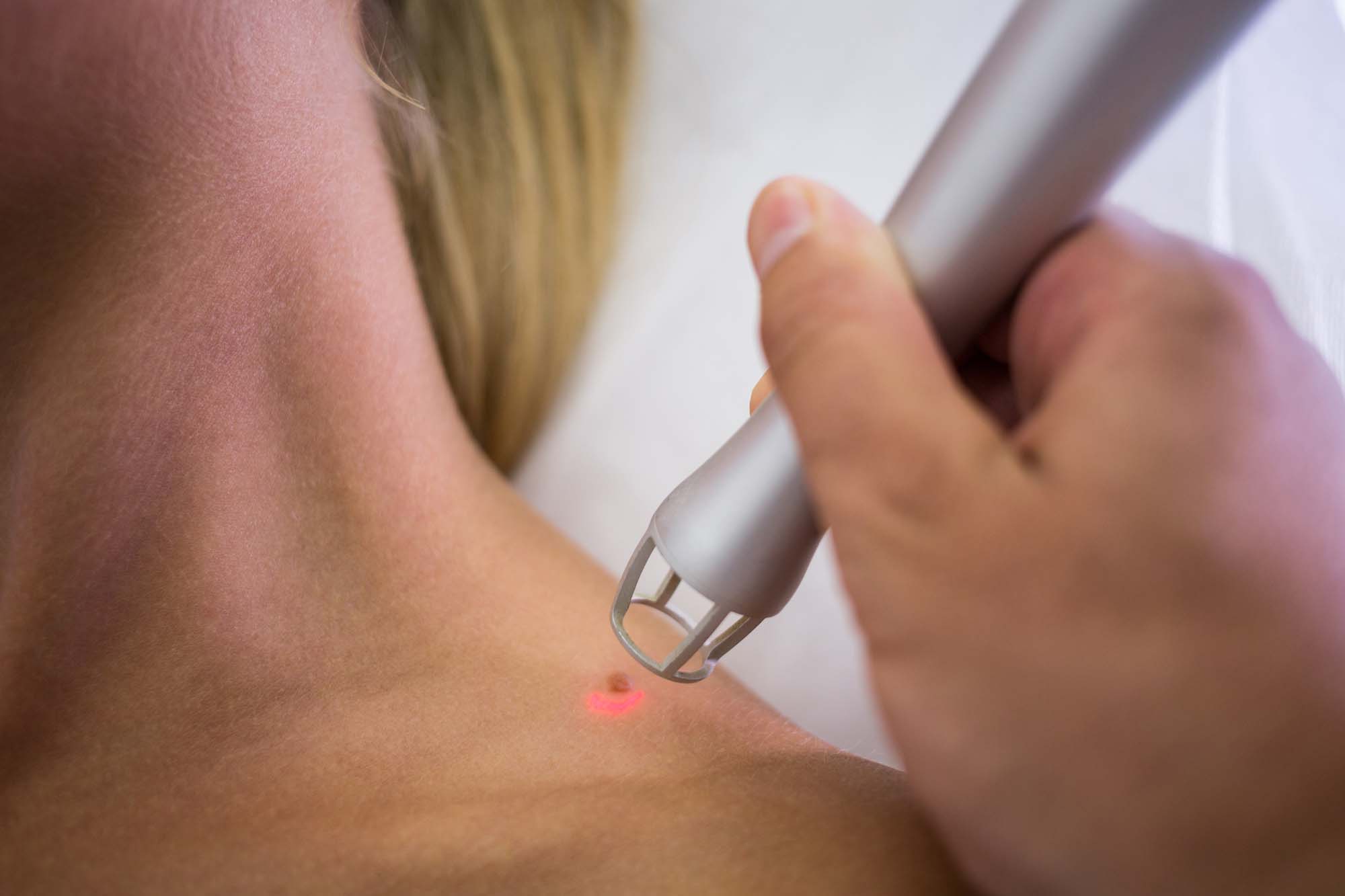 Laser pigmentation removal treatment